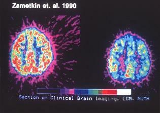 kliničko snimanje mozga na adhd